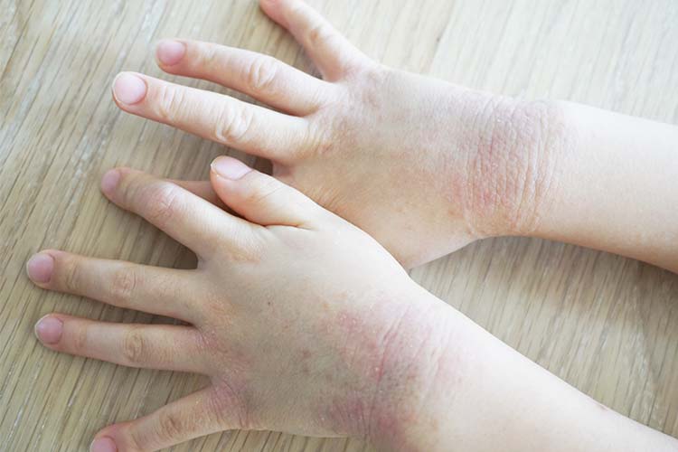 アトピー性皮膚炎のイメージ画像